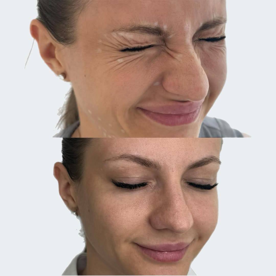 Ботулинотерапия
