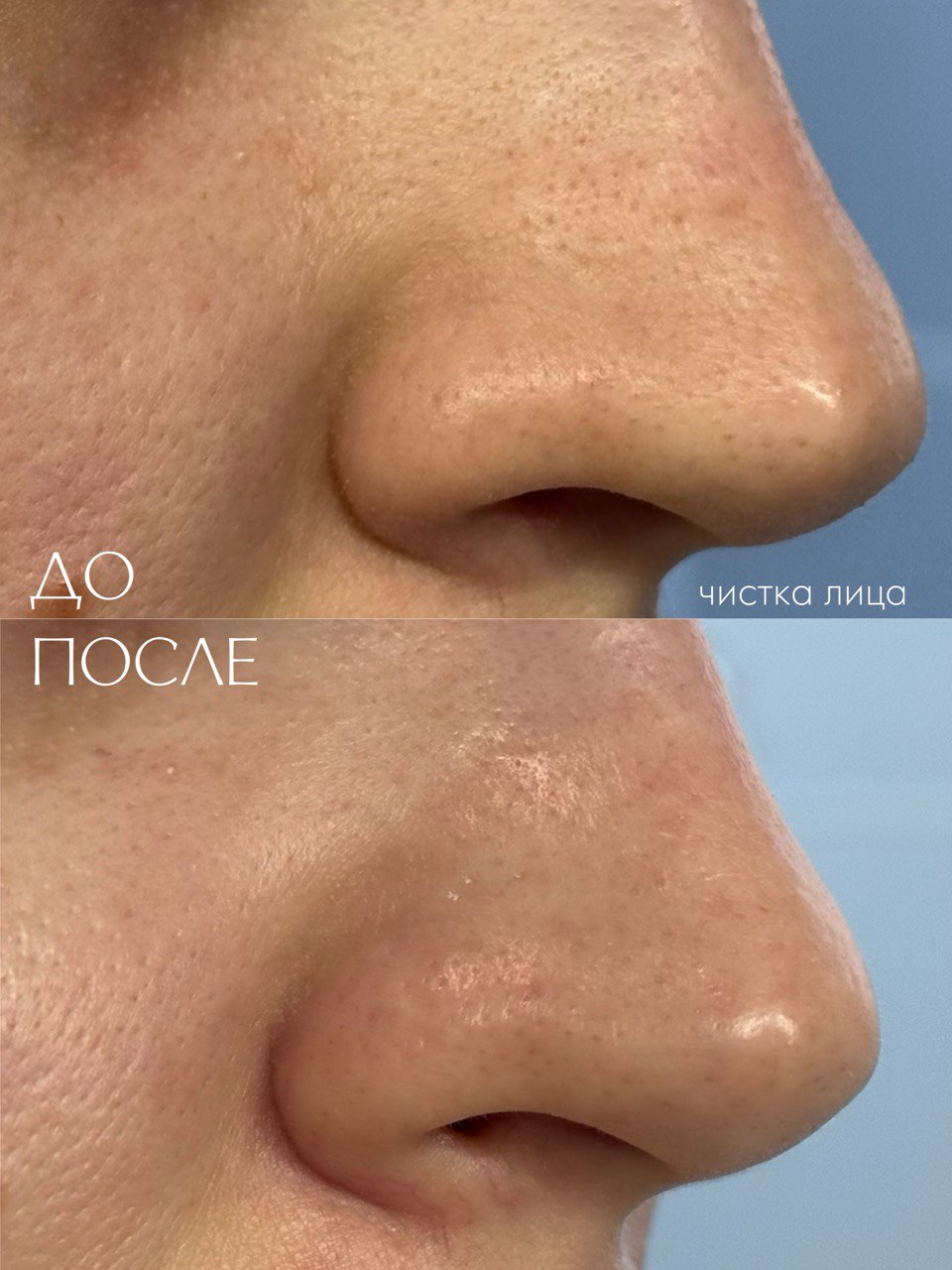 Чистка лица на аппарате Profacial