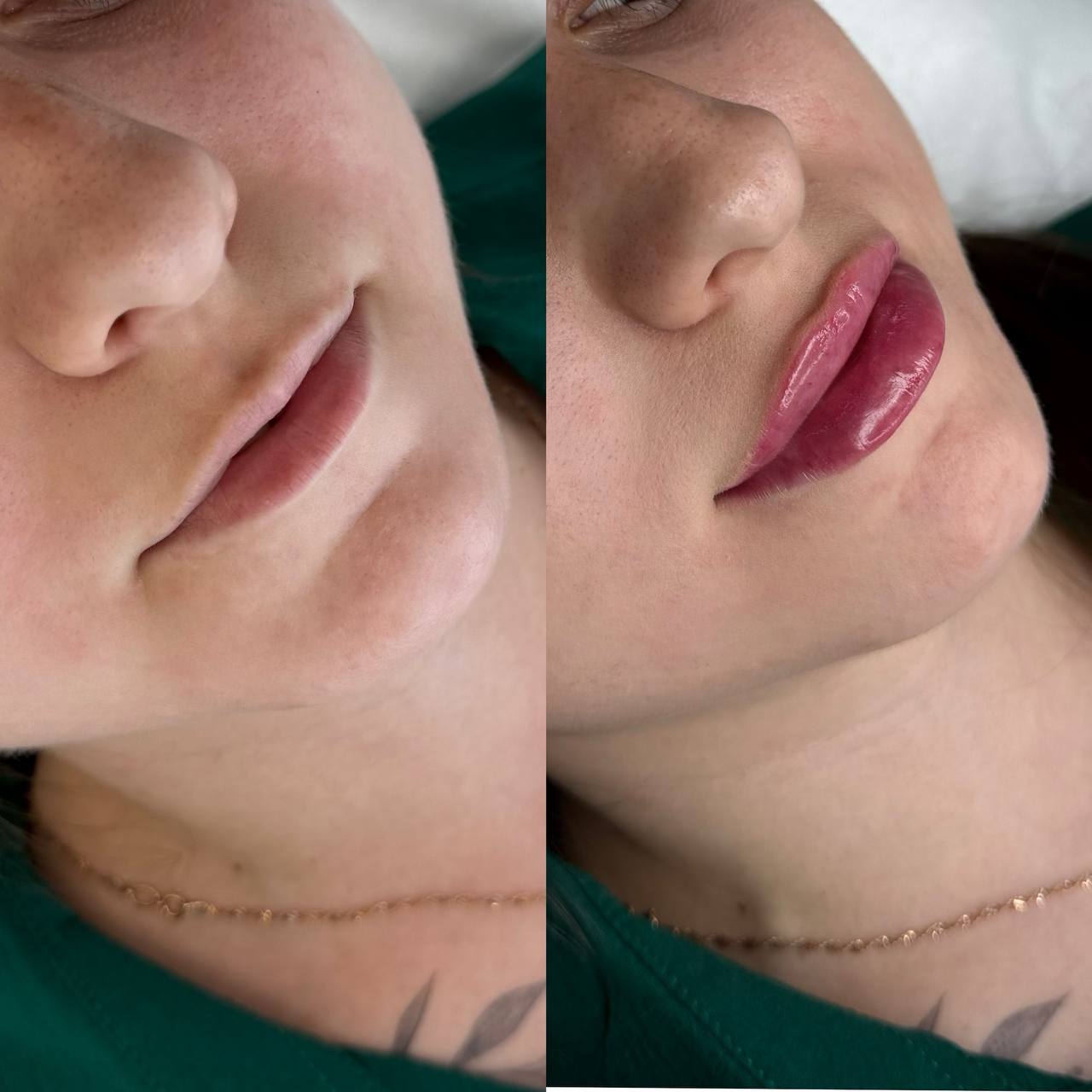 Контурная пластика-пример