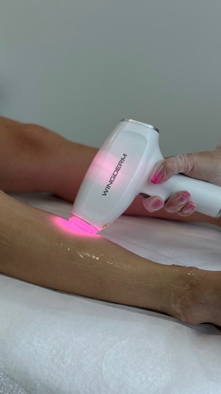 Лазерная эпиляция на аппарате Wingderm