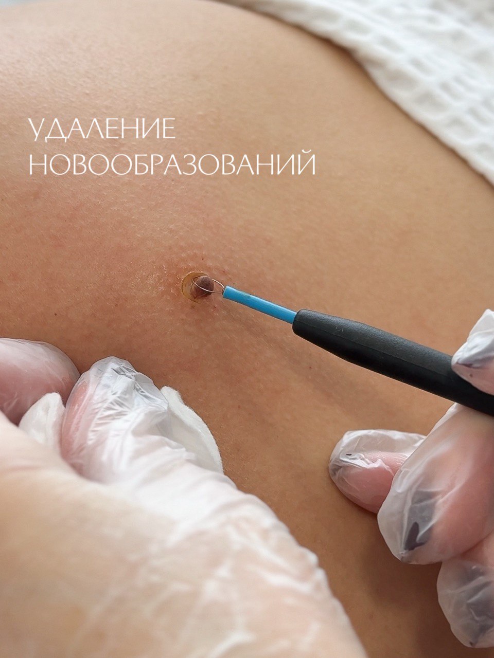 Электрохирургический радиоволновой коагулятор