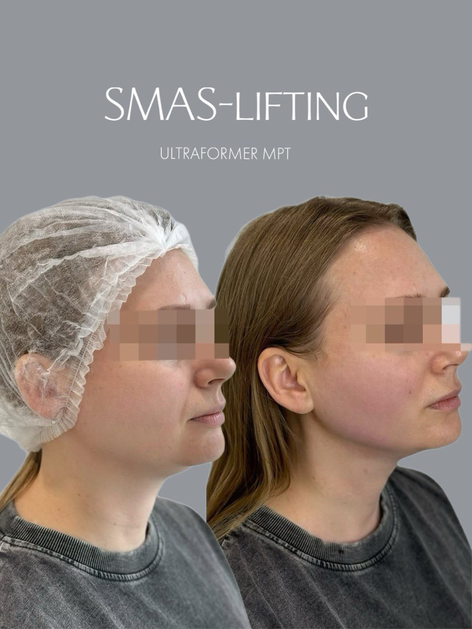 SMAS-лифтинг